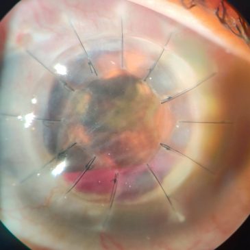 CORNEAL TRANSPLANT