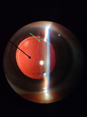 Cataract