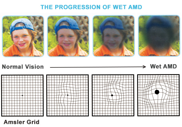 age-related-macular-degeneration