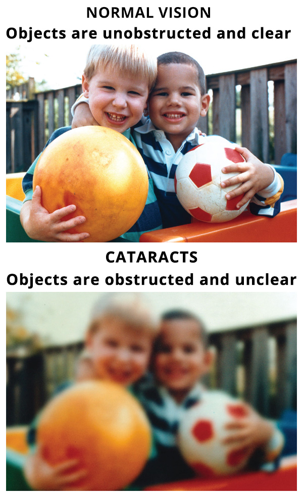 cataract-surgery-cost