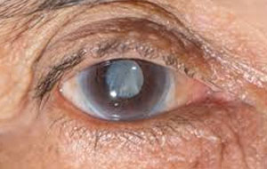 cataract