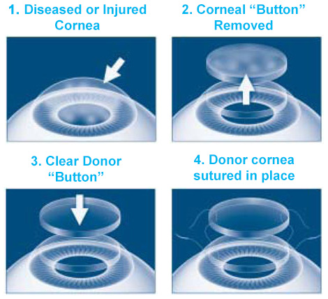 cornea-transplant