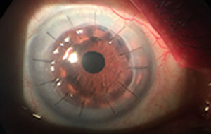 cornea