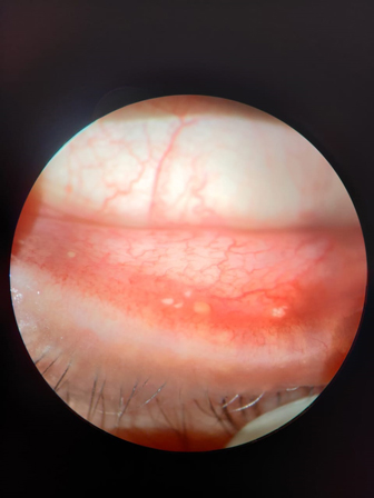 Eye Allergy - JEhan Eye Clinic