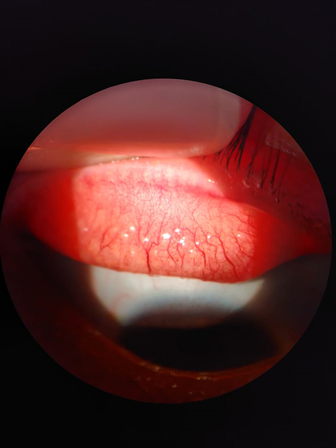 Eye Allergy