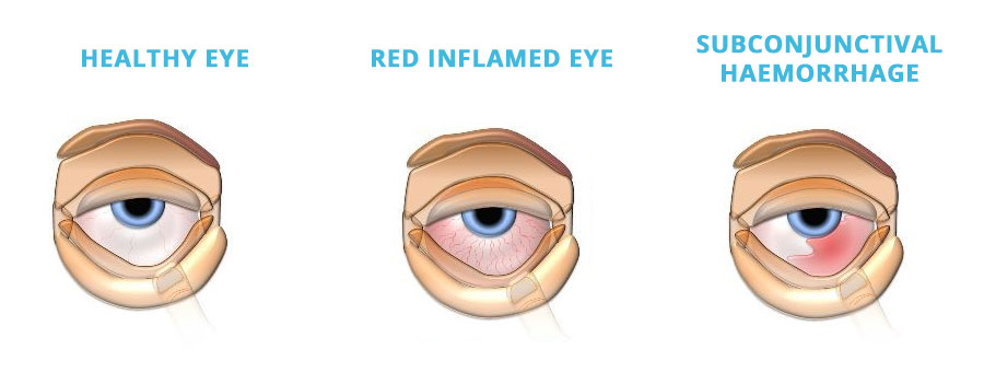 eye-infections