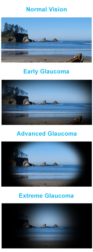 glucoma-symptoms-and-treatments