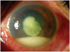 INFECTIONS OF THE EYE