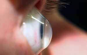 keratoconus