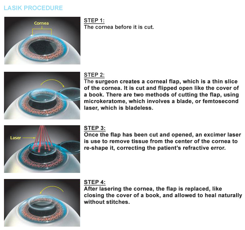lasik-eye-surgery-procedure