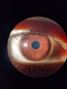 normal-eye-with-clear-cornea