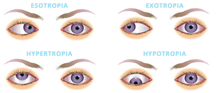 squint-eye-treatment