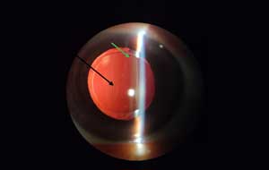 cataract-surgery