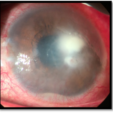 What is Corneal Ulcer?