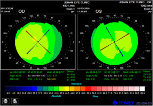 Topography Of Keratoconus Patient