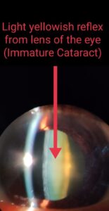 PHOTO OF IMMATURE CATARACT Immature CATARACT