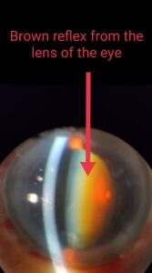 MATURE CATARACT