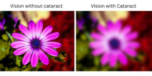 cataract vision